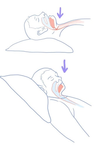 Graphic showing how lying down narrows your throat.